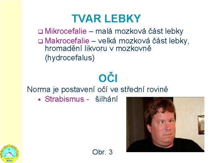 TVAR LEBKY Mikrocefalie – malá mozková část lebky q Makrocefalie – velká mozková část