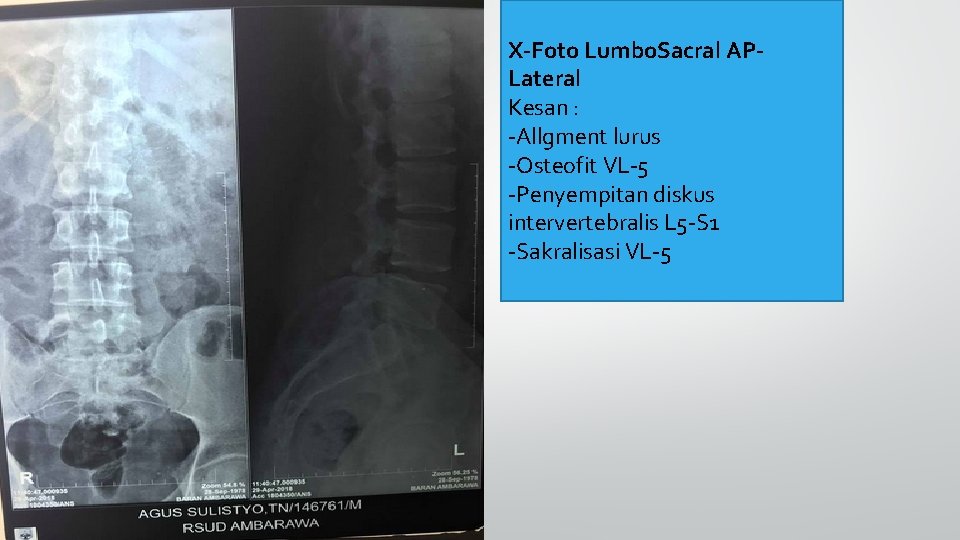 X-Foto Lumbo. Sacral APLateral Kesan : -Allgment lurus -Osteofit VL-5 -Penyempitan diskus intervertebralis L