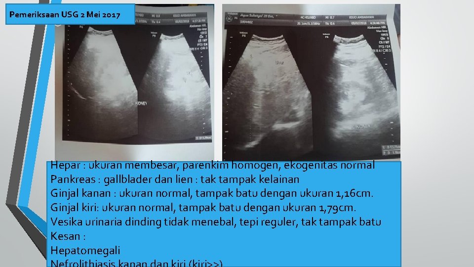 Pemeriksaan USG 2 Mei 2017 Hepar : ukuran membesar, parenkim homogen, ekogenitas normal Pankreas