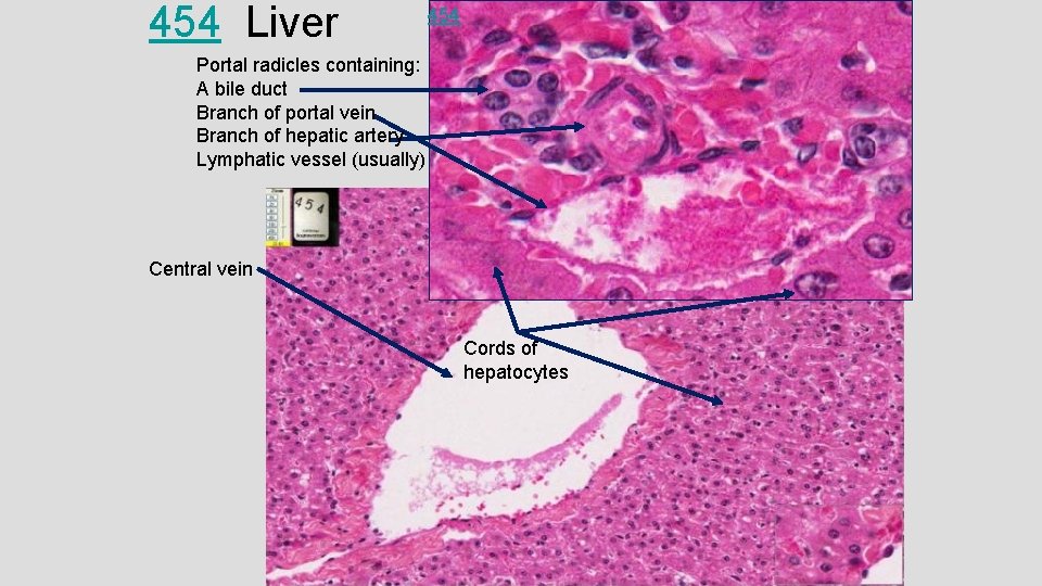 454 Liver 454 Portal radicles containing: A bile duct Branch of portal vein Branch