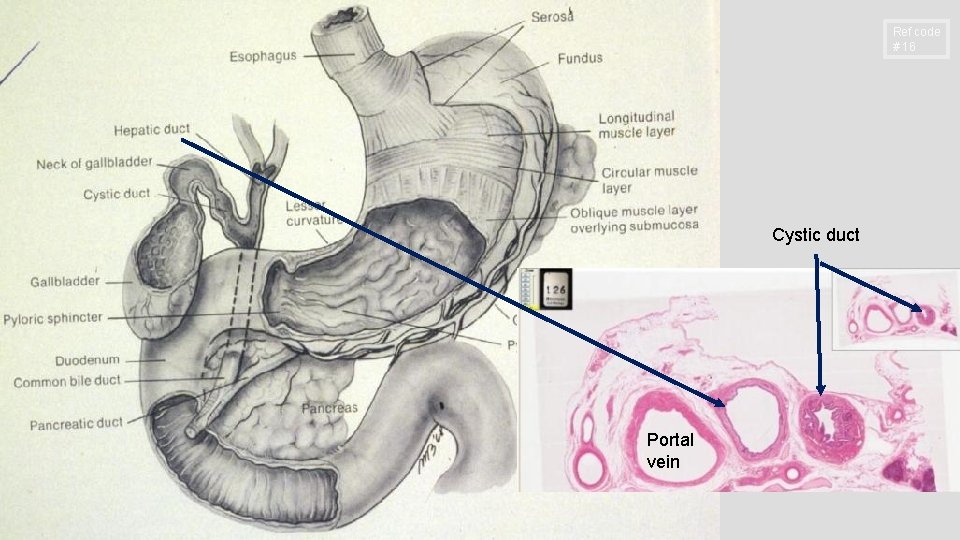 Ref code # 16 Cystic duct Portal vein 