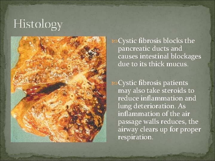 Histology Cystic fibrosis blocks the pancreatic ducts and causes intestinal blockages due to its