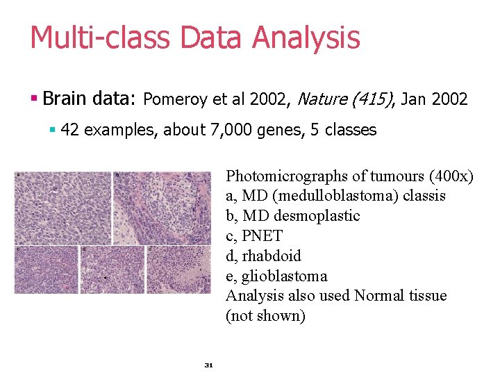 Multi-class Data Analysis § Brain data: Pomeroy et al 2002, Nature (415), Jan 2002 Multi-class Data Analysis § Brain data: Pomeroy et al 2002, Nature (415), Jan 2002