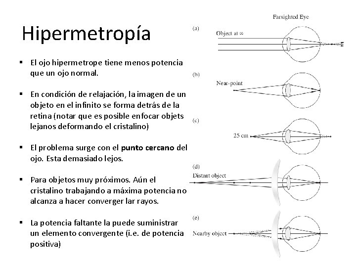 Hipermetropía § El ojo hipermetrope tiene menos potencia que un ojo normal. § En