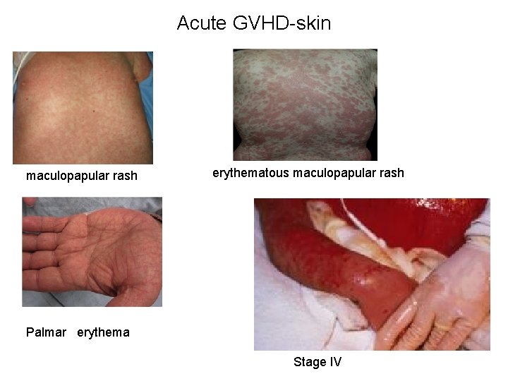 Acute GVHD-skin maculopapular rash erythematous maculopapular rash Palmar erythema Stage IV 