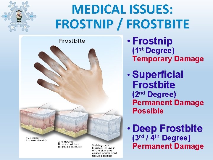MEDICAL ISSUES: FROSTNIP / FROSTBITE • Frostnip (1 st Degree) Temporary Damage • Superficial