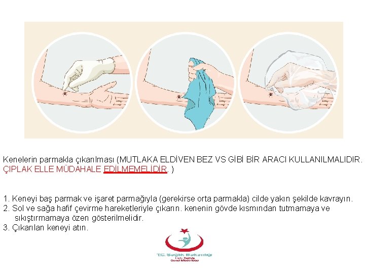 Kenelerin parmakla çıkarılması (MUTLAKA ELDİVEN BEZ VS GİBİ BİR ARACI KULLANILMALIDIR. ÇIPLAK ELLE MÜDAHALE