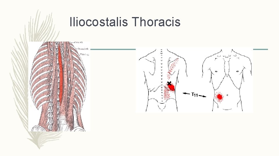 Iliocostalis Thoracis Iliocostalis Thoracis