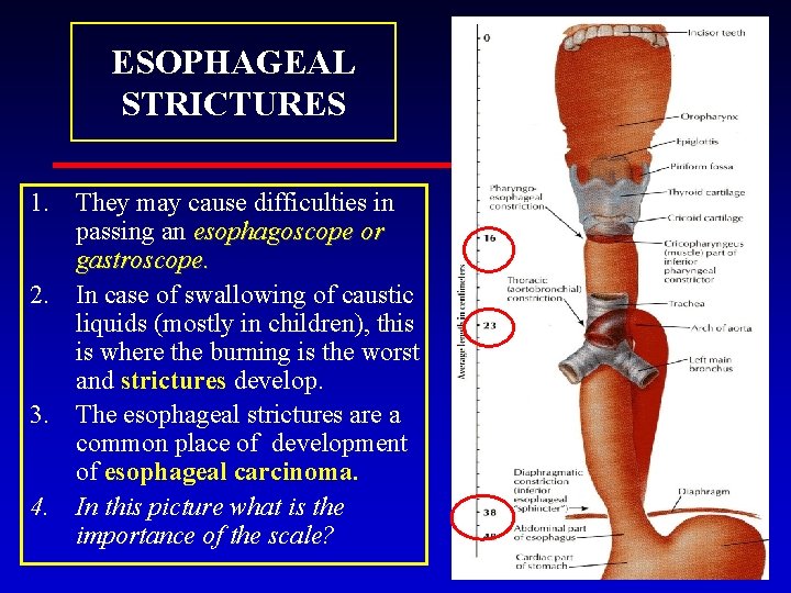 ESOPHAGEAL STRICTURES 1. They may cause difficulties in passing an esophagoscope or gastroscope. 2.