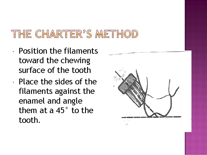  Position the filaments toward the chewing surface of the tooth Place the sides