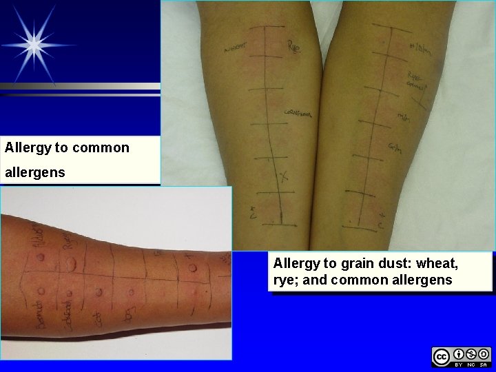 Allergy to common allergens Allergy to grain dust: wheat, rye; and common allergens 