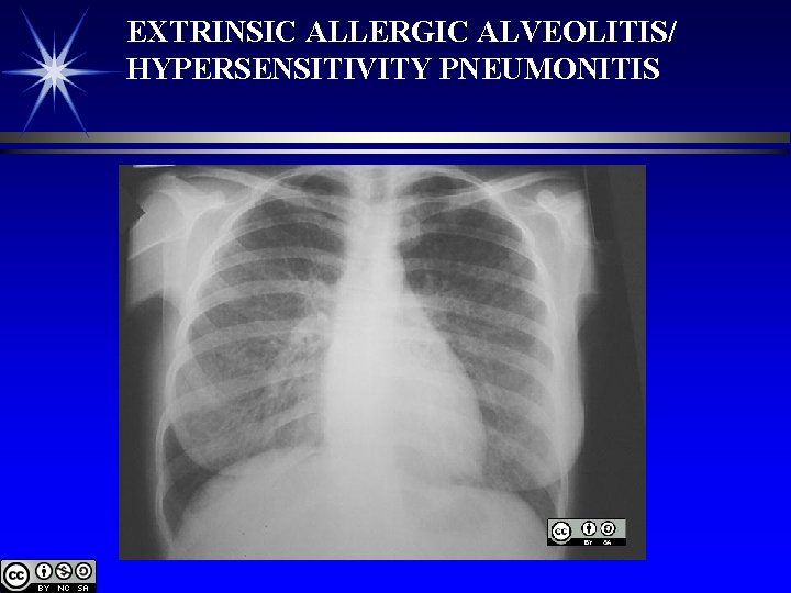 EXTRINSIC ALLERGIC ALVEOLITIS/ HYPERSENSITIVITY PNEUMONITIS 