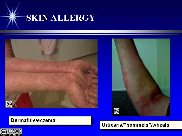 SKIN ALLERGY Dermatitis/eczema Urticaria/”bommels”/wheals 