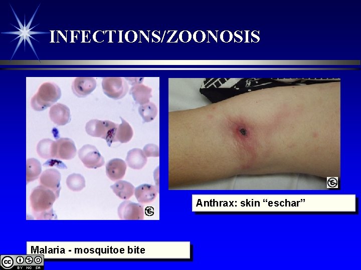INFECTIONS/ZOONOSIS Anthrax: skin “eschar” Malaria - mosquitoe bite 