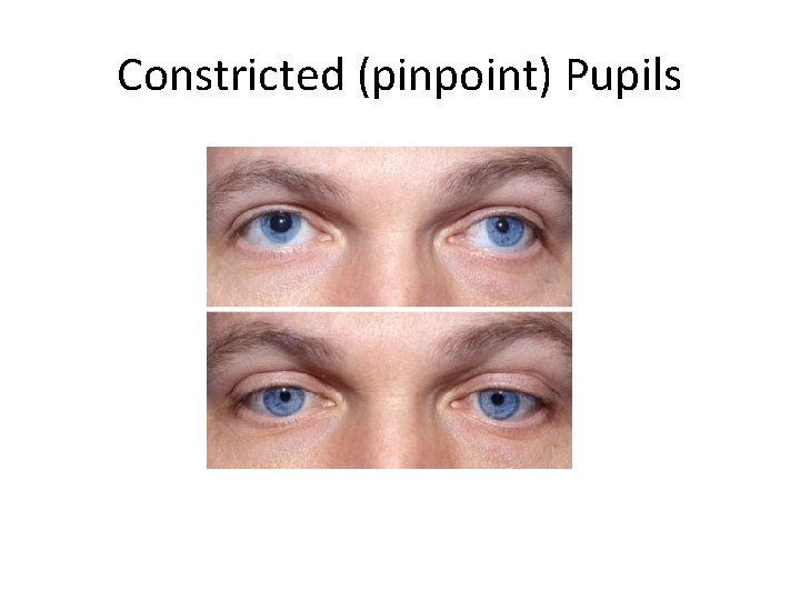 Constricted (pinpoint) Pupils 