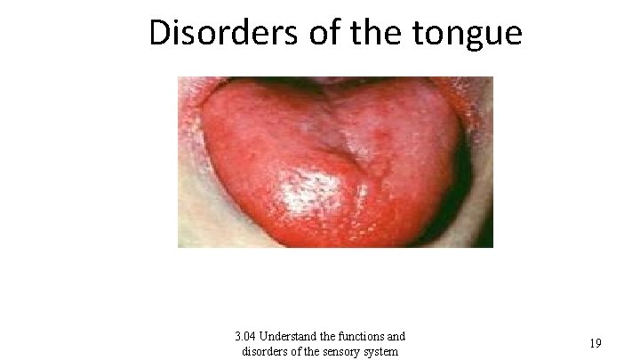 Disorders of the tongue 3. 04 Understand the functions and disorders of the sensory
