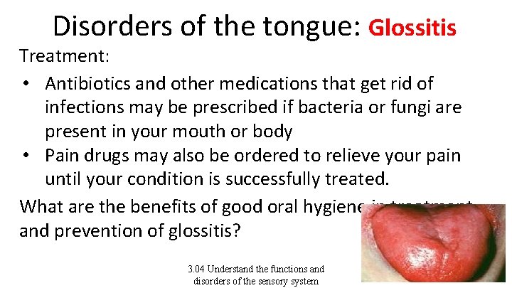 Disorders of the tongue: Glossitis Treatment: • Antibiotics and other medications that get rid