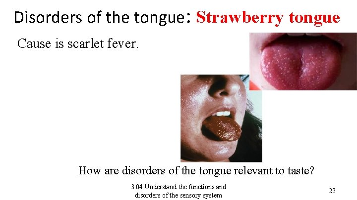 Disorders of the tongue: Strawberry tongue Cause is scarlet fever. How are disorders of