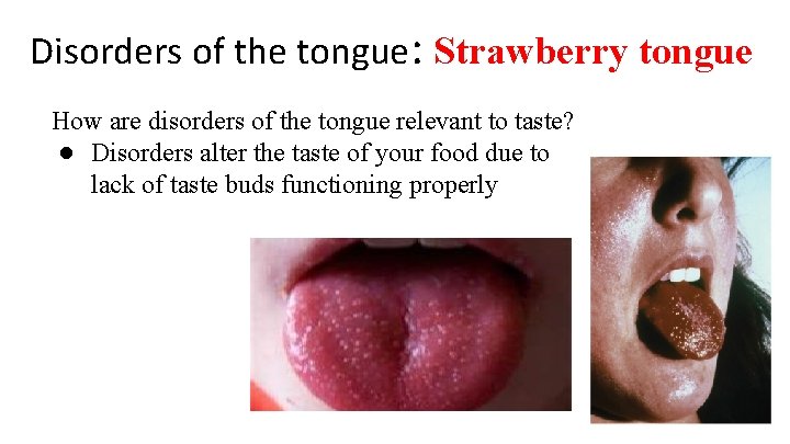 Disorders of the tongue: Strawberry tongue How are disorders of the tongue relevant to