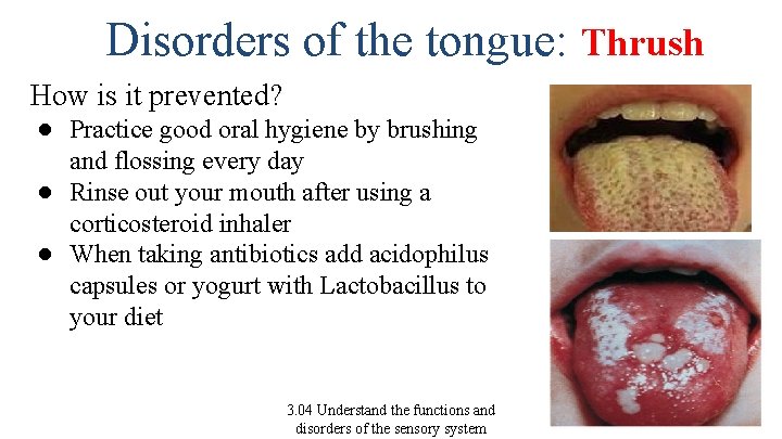 Disorders of the tongue: Thrush How is it prevented? ● Practice good oral hygiene