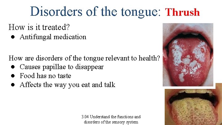 Disorders of the tongue: Thrush How is it treated? ● Antifungal medication How are