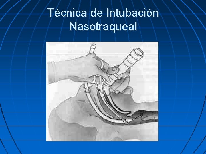 Técnica de Intubación Nasotraqueal 