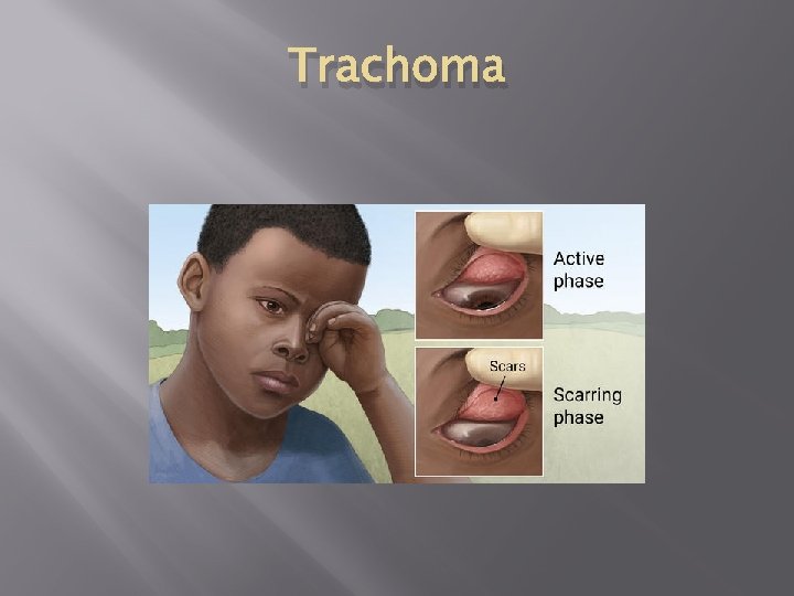 Trachoma 