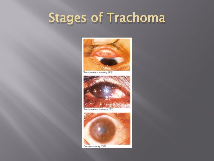Stages of Trachoma 