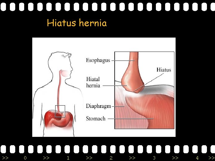 Hiatus hernia >> 0 >> 1 >> 2 >> 3 >> 4 >> 