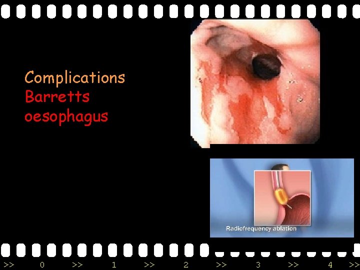 Complications Barretts oesophagus >> 0 >> 1 >> 2 >> 3 >> 4 >>