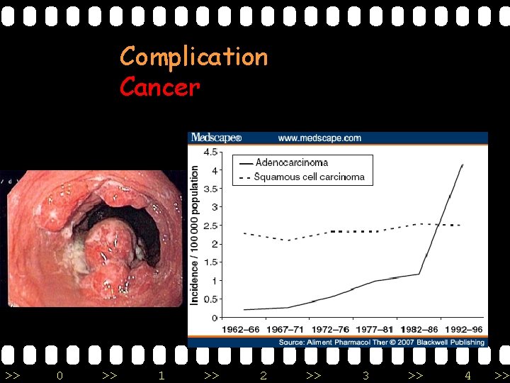 Complication Cancer >> 0 >> 1 >> 2 >> 3 >> 4 >> 