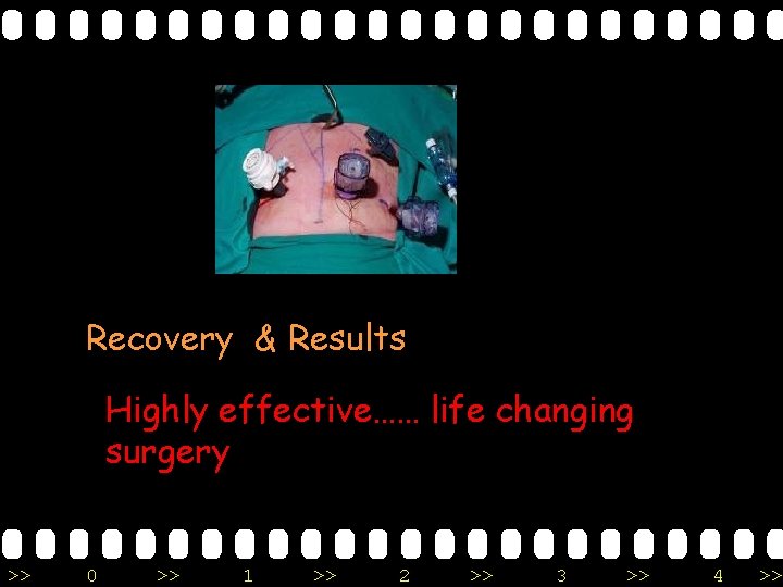 Recovery & Results Highly effective…… life changing surgery >> 0 >> 1 >> 2