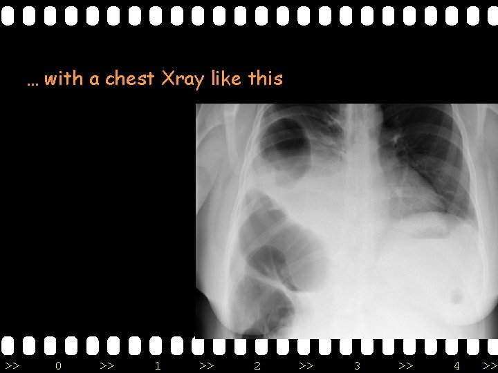 … with a chest Xray like this >> 0 >> 1 >> 2 >>