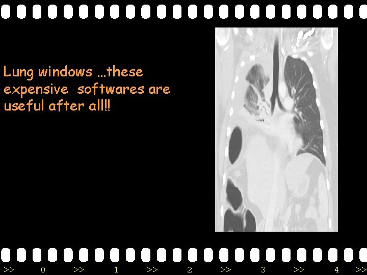 Lung windows …these expensive softwares are useful after all!! >> 0 >> 1 >>