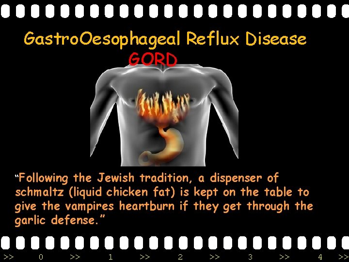 Gastro. Oesophageal Reflux Disease GORD “Following the Jewish tradition, a dispenser of schmaltz (liquid