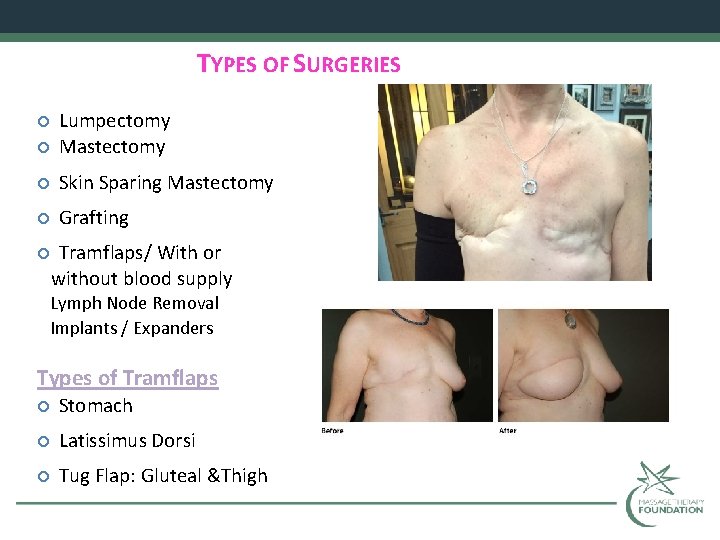 TYPES OF SURGERIES Lumpectomy Mastectomy Skin Sparing Mastectomy Grafting Tramflaps/ With or without blood