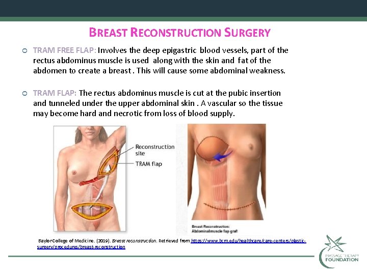 BREAST RECONSTRUCTION SURGERY TRAM FREE FLAP: Involves the deep epigastric blood vessels, part of