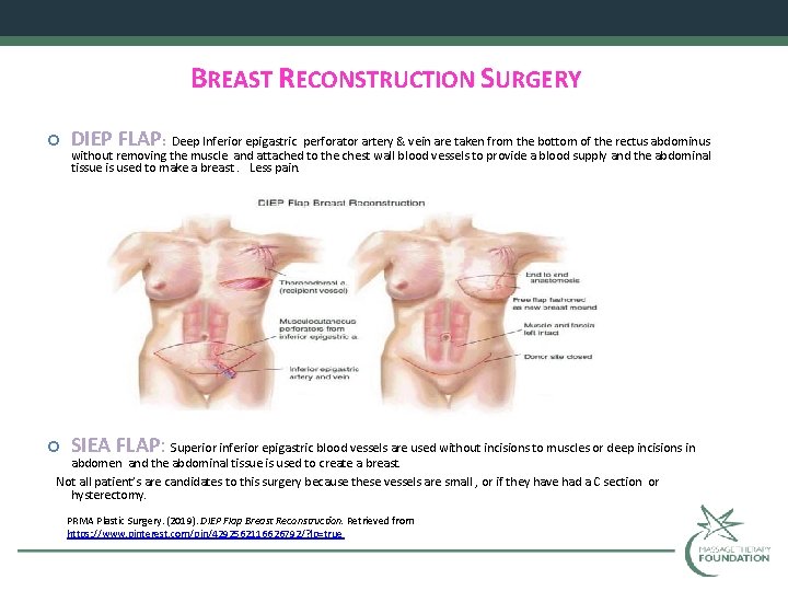 BREAST RECONSTRUCTION SURGERY DIEP FLAP: Deep Inferior epigastric perforator artery & vein are taken
