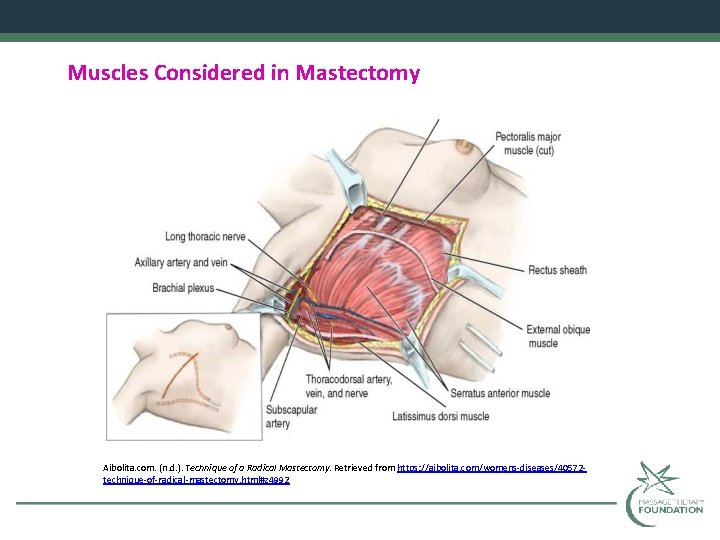 Muscles Considered in Mastectomy Aibolita. com. (n. d. ). Technique of a Radical Mastectomy.