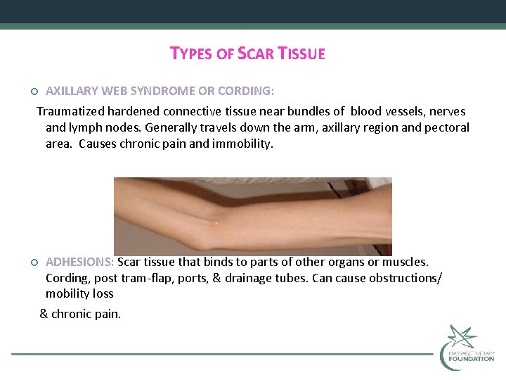 TYPES OF SCAR TISSUE AXILLARY WEB SYNDROME OR CORDING: Traumatized hardened connective tissue near