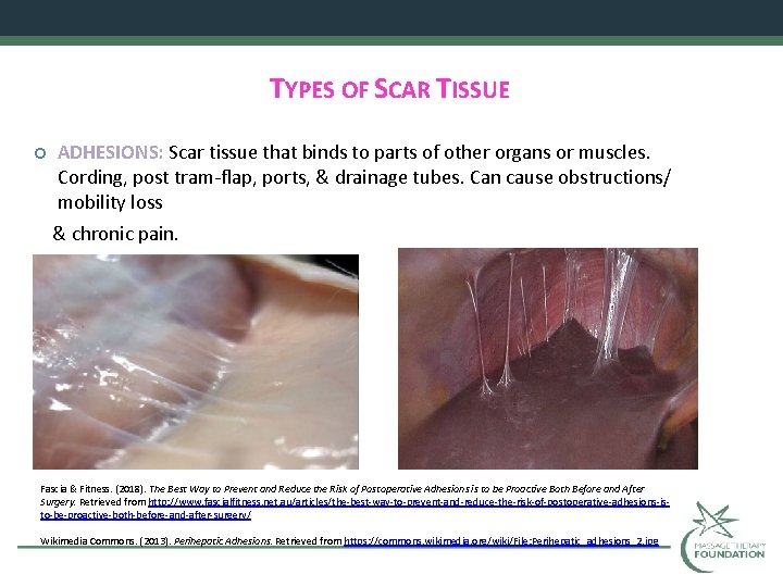 TYPES OF SCAR TISSUE ADHESIONS: Scar tissue that binds to parts of other organs