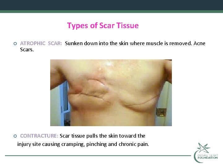 Types of Scar Tissue ATROPHIC SCAR: Sunken down into the skin where muscle is