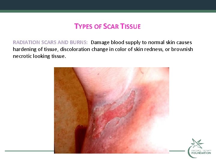 TYPES OF SCAR TISSUE RADIATION SCARS AND BURNS: Damage blood supply to normal skin