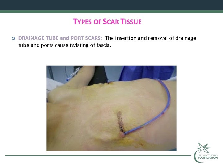 TYPES OF SCAR TISSUE DRAINAGE TUBE and PORT SCARS: The insertion and removal of