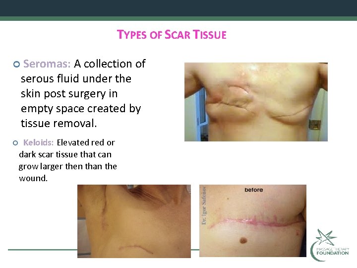 TYPES OF SCAR TISSUE Seromas: A collection of serous fluid under the skin post