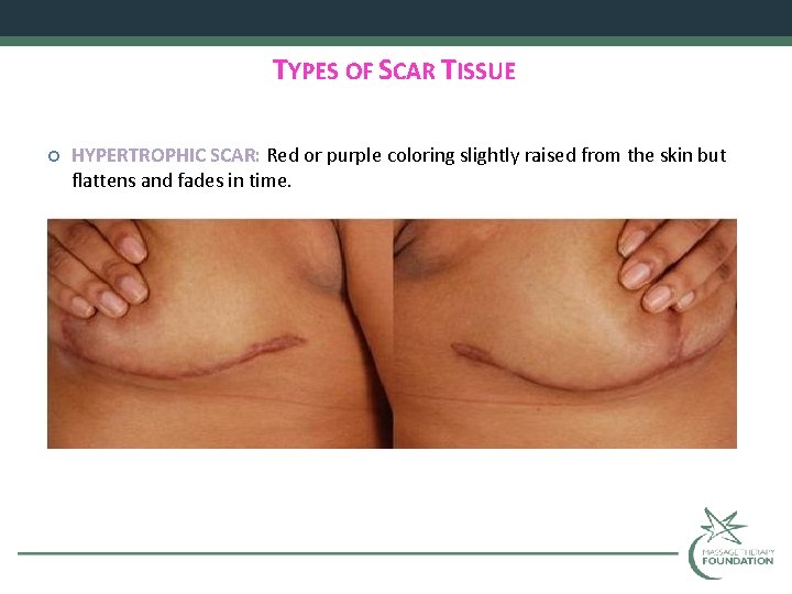 TYPES OF SCAR TISSUE HYPERTROPHIC SCAR: Red or purple coloring slightly raised from the