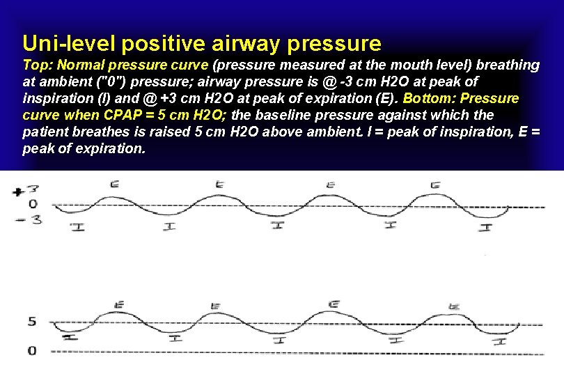 Uni-level positive airway pressure Top: Normal pressure curve (pressure measured at the mouth level)