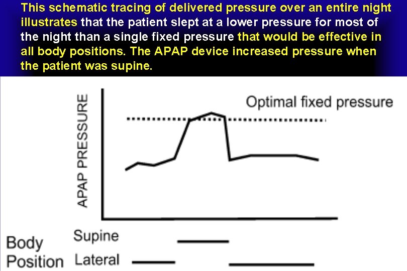This schematic tracing of delivered pressure over an entire night illustrates that the patient