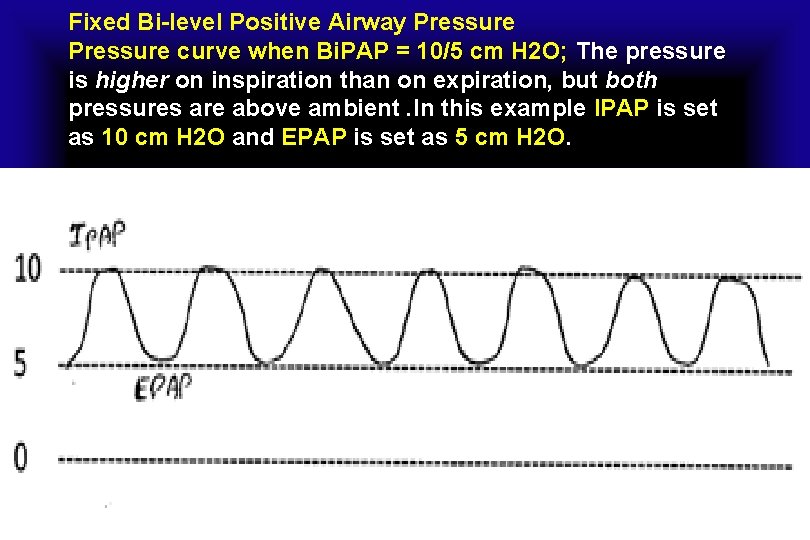 Fixed Bi-level Positive Airway Pressure curve when Bi. PAP = 10/5 cm H 2