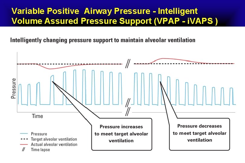 Variable Positive Airway Pressure - Intelligent Volume Assured Pressure Support (VPAP - i. VAPS